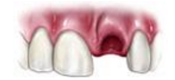 Traumatic Dental Injuries & Trauma to the Teeth - endodontics | bartram park